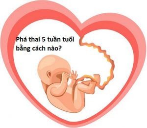 Phá thai 5 tuần tuổi bằng cách nào an toàn