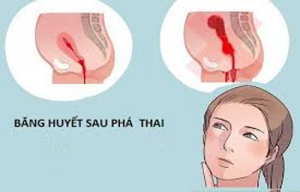 Phá thai bằng thuốc bị băng huyết có nguy hiểm không