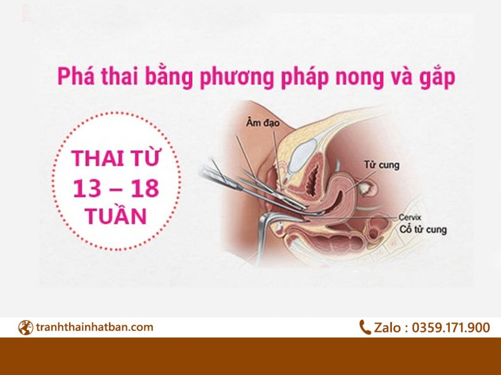 Phương pháp phá thai an toàn với cách nong, gắp thai