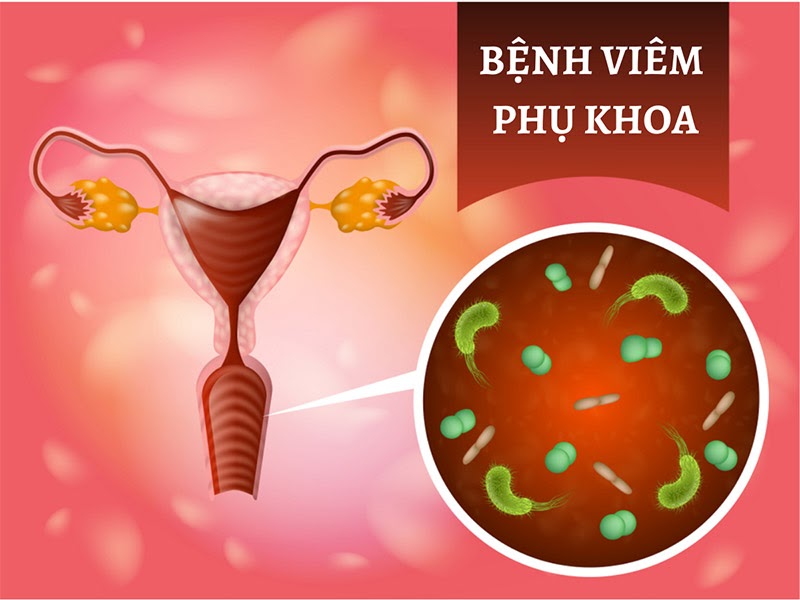 Viêm nhiễm phụ khoa